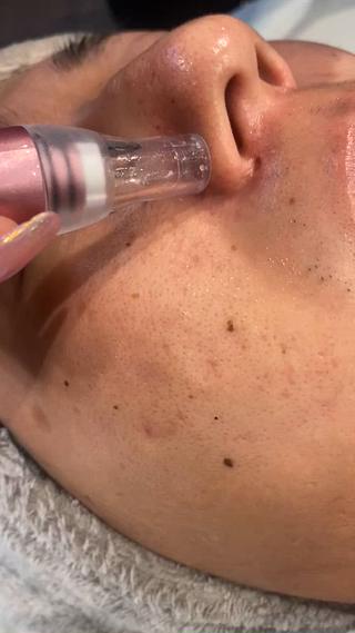 ハーブピーリング/韓国肌管理/フェイシャル/毛穴洗浄/眉毛/顔脱毛【糸脱毛専門】rev所属・ハーブピーリング🌹 毛穴洗浄❤️眉waxのエステ・リラクイメージ