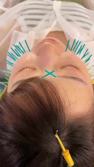 100回のエステより1回の美容鍼！ 