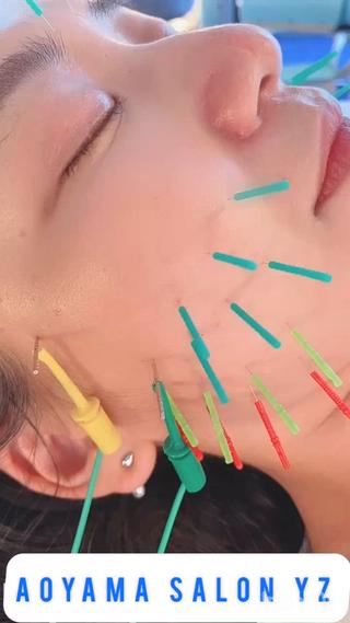 YZ式美容鍼で極限までリフトアップ！
・ほうれい線
・マリオネット
・口角アップ
・エラ張り
・左右差 