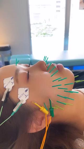 顔がピクピク動く【電気を流す美容鍼】がバズり中♪ 