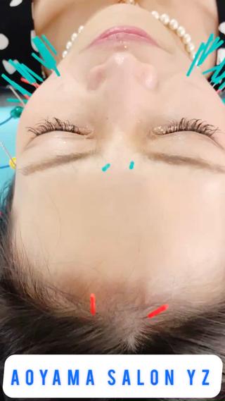 美容鍼×EMS(電気)が一番人気です！

表情筋のトレーニングが寝てるだけでできますよ♪ 