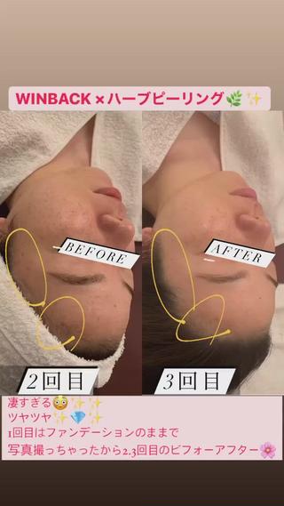 Before After ハーブピーリング 