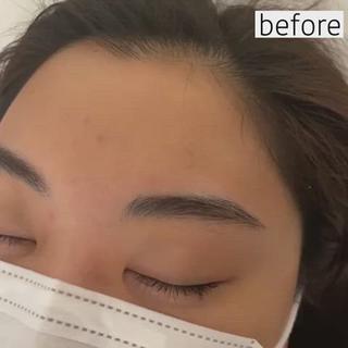 もともと整った眉毛でしたが
ハリウッドブロウリフトでよりきれいな眉毛に

眉尻がキリッと引きしまりました 