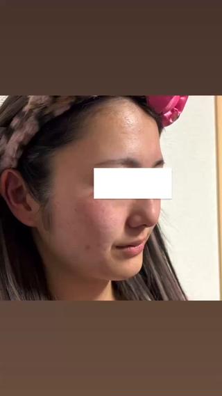 パック愛用before▼▼▼▼▼after
これは1日目と5日目の比較です！

変わってるところは
	•	赤みがかなり落ち着いてる
	•	肌トーンが均一になってる
	•	ツヤ感アップ
	•	毛穴・ザラつき感が目立ちにくい

何でも三日坊主だった私が今ではパック1袋無くなるまで毎日使えてるのはやればやるほど効果がすごいから。。

皆さんも1回お試し¥2,200円でできます！
ご予約お待ちしております 