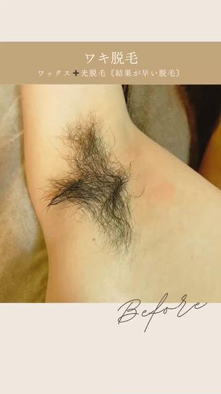 ワキ脱毛✧*｡٩(ˊωˋ*)و✧*｡ 