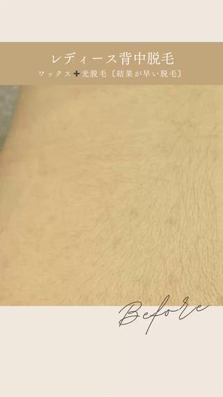 レディース背中脱毛( * ॑꒳ ॑*) 