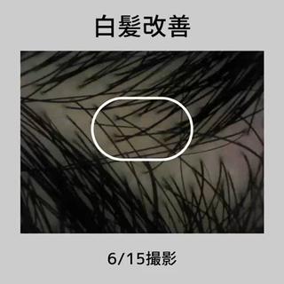 《白髪改善》　　6月15日撮影
※ご本人より許可を得て掲載させていただいております

現在
月1サロンケア
ホームケア中心で頭皮ケア

【MONNALI】
・MIHATSUシャンプー
・MIHATSUトリートメント
(毛先には別のトリートメントを使われる事もある、と)
・スカルプミスト　クリーン
・育毛剤　グロウ(時折忘れることもあった、とお話されていました)

【インナーケア】
らせった堂　リボンスイート
初施術より現在8ヶ月目

継続は力なり、ですね︎

薬に頼らない育毛発毛促進サロン　Ｌ＋ 