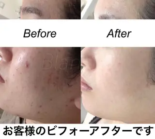 ロング パーマ ヘアアレンジ キッズ ネイル マツエク・マツパ 都度払い肌質改善 &脱毛Blancheのエステ・リラクイメージ