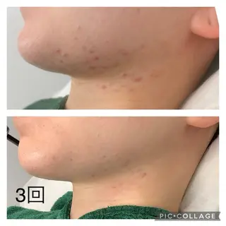 BLANC.【新宿店】所属・ハーブピーリング ayamiのエステ・リラクイメージ