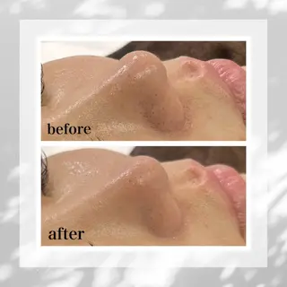 フローフシ∞💙 毛穴洗浄で毛穴レスのエステ・リラクイメージ