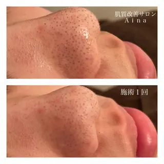 ミディアム カラー パーマ ヘアアレンジ メンズ キッズ ネイル マツエク・マツパ ニキビ跡専門サロン Ainaのエステ・リラクイメージ