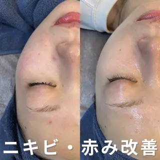 ニキビ・ニキビ跡改善 leoloのエステ・リラクイメージ