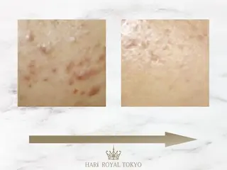 ハリロイヤルトーキョー武蔵小山所属・ニューハーフ鍼灸師 🖤🤍Saya🌹のエステ・リラクイメージ