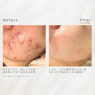繰り返すニキビを改善 ✨つくば肌質改善専門のエステ・リラクイメージ