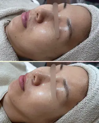 |ピーリング・毛穴| soina神楽坂のエステ・リラクイメージ