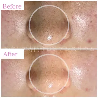 毛穴ケア専門サロンアンスリウム所属・茨城土浦 つくば毛穴 ケア専門サロンのエステ・リラクイメージ