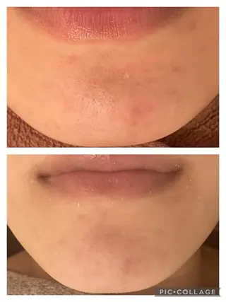 ロング カラー パーマ ヘアアレンジ メンズ キッズ ネイル マツエク・マツパ アイブロウ 🔥3か月で肌革命 🔥ニキビ専門店のエステ・リラクイメージ