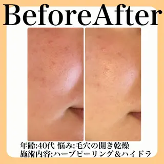 毛穴・たるみ･ニキビケア専門サロンsui所属・sui【スイ】 ARISAのエステ・リラクイメージ