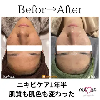 Meupニキビ専門店 背中/ハーブ/肌管理のその他イメージ