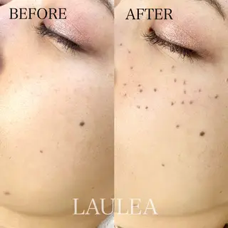 シミケア/ハーブピーリング/脱毛/小顔フェイシャル/ハーブ温浴　LAULEA所属・素肌をキレイに ラウレア🌼Hayaのエステ・リラクイメージ