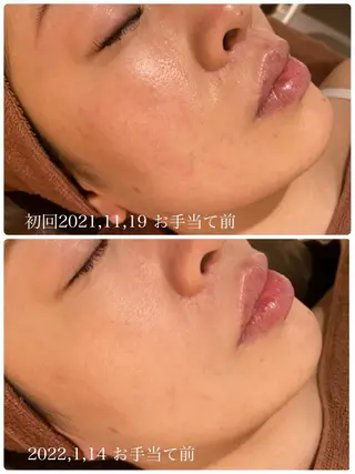 学生ニキビ改善🍀 優しい肌質改善のエステ・リラクイメージ