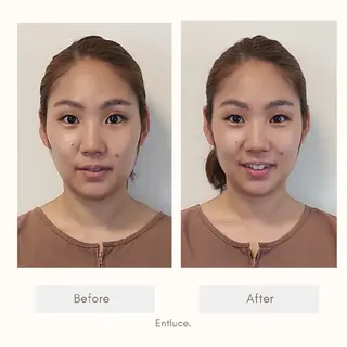 即効⚡小顔美容鍼🪡 むくみたるみ脂肪解消のエステ・リラクイメージ