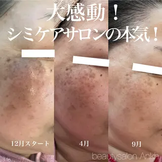 【しみ毛穴専門店】beautysalon Ankh所属・しみ毛穴専門店 Ankh 平田のエステ・リラクイメージ