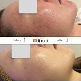 毛穴専門店Bébé 大阪中央店のエステ・リラクイメージ