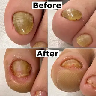 ネイル Mellow nail所属・巻爪無料モデル募集 ✨🦶MEGUMIのネイルデザイン