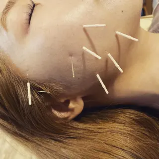むくみたるみ専門☆ 美容鍼・小顔矯正のエステ・リラクイメージ