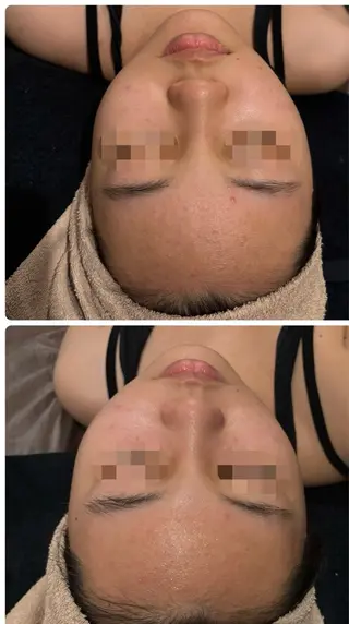 【リベルハーブピーリング認定店】敏感肌・美白脱毛専門店Dione立川店所属・Dione 立川店のエステ・リラクイメージ