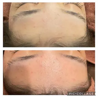 ニキビ跡改善専門🔥 医療にはできない改善のエステ・リラクイメージ