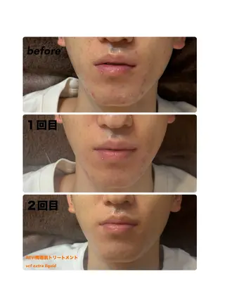 ハーブピーリング/韓国肌管理/フェイシャル/毛穴洗浄/眉毛/顔脱毛【糸脱毛専門】rev所属・ハーブピーリング🌹 毛穴洗浄❤️眉waxのエステ・リラクイメージ