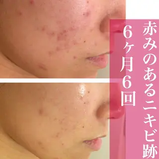 6万人の美肌実績🔥 最短ニキビ改善のエステ・リラクイメージ