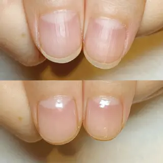 ネイル 深爪矯正/爪育成ケア manie nailのネイルデザイン