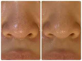 ハーブピーリング🌿 脱毛🧡ヘッドスパのエステ・リラクイメージ