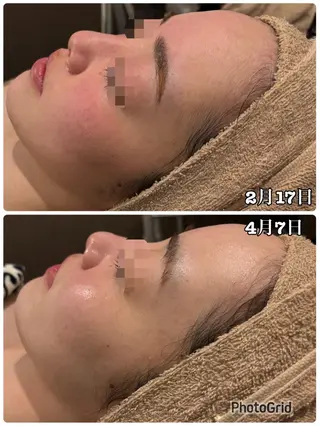 【リベルハーブピーリング認定店】敏感肌・美白脱毛専門店Dione立川店所属・Dione 立川店のエステ・リラクイメージ