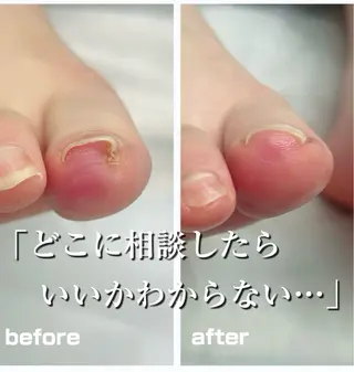 巻き爪フットケアサロンKotori所属・フットケアサロン Kotoriのその他イメージ