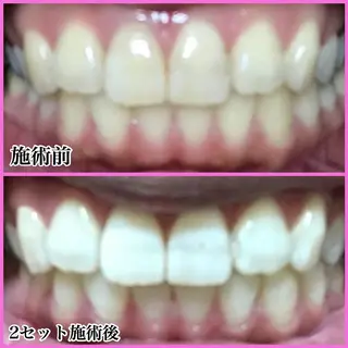 ネイル/耳つぼ /新ホワイトニングのネイルデザイン