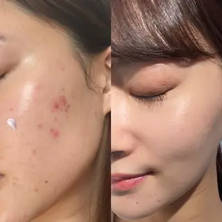 グリーンピール専門店 🌿エルモナのエステ・リラクイメージ