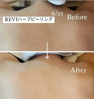 🌿ハーブピーリング ・脱毛◆Refreのエステ・リラクイメージ