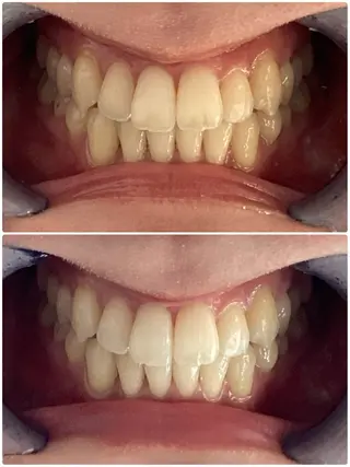 ANGEPEAU（アンジュポー）所属・セルフホワイトニング アンジュポーのその他イメージ