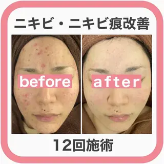 セミロング カラー パーマ ヘアアレンジ メンズ キッズ ネイル マツエク・マツパ アイブロウ 🔥3か月で肌革命 🔥ニキビ専門店のエステ・リラクイメージ