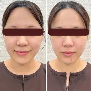 【美容鍼・小顔鍼】 鍼灸師　吉田洋美のその他イメージ