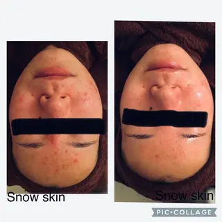 ニキビ/肌質改善専門 Snow skinのエステ・リラクイメージ