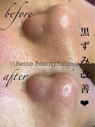 Reine BeautySalon所属・毛穴/シミ肝斑/脱毛 横山梨里のエステ・リラクイメージ