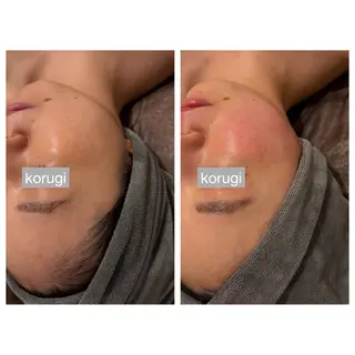 ☆痩身/小顔☆ ハイパーナイフexのエステ・リラクイメージ