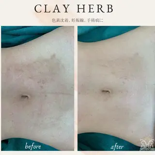 【剥離ありハーブピーリング専門エステ】cerisier BEAUTÉ 原宿所属・cerisier BEAUTÉのエステ・リラクイメージ