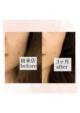 hitohana所属・毛穴/いちご鼻/小顔 /hitohanaのエステ・リラクイメージ