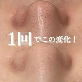 学生ニキビ改善🍀 優しい肌質改善のエステ・リラクイメージ